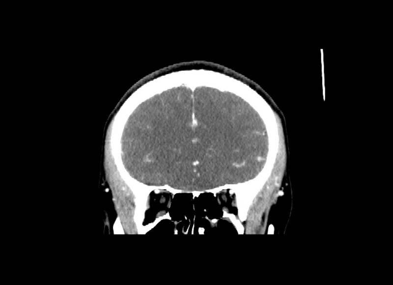 File:Cerebral edema (Radiopaedia 82519-96661 C 45).jpg