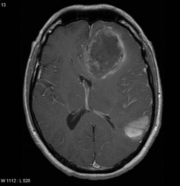 File:Cerebral metastases - renal cell carcinoma (Radiopaedia 5510-7246 Axial T1 C+ 5).jpg