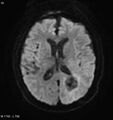 Cerebral radiation necrosis (Radiopaedia 5665-7376 Axial DWI 1).jpg