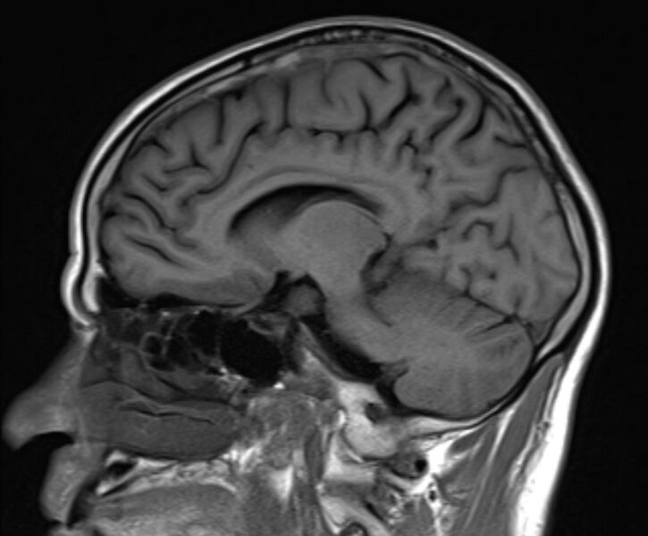 File:Cerebral venous thrombosis (Radiopaedia 71207-81504 Sagittal T1 15).jpg