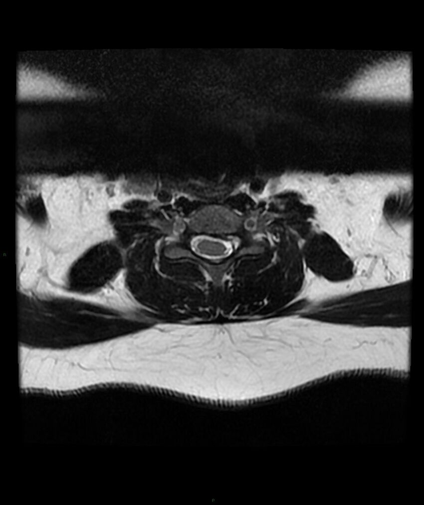 Cervical disc prolapse (Radiopaedia 80258-93598 Axial T2 48).jpg