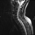 Cervical dural CSF leak on MRI and CT treated by blood patch (Radiopaedia 49748-54995 Sagittal T2 8).png