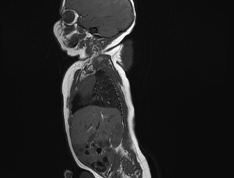 File:Cervical myelomeningocele (Radiopaedia 69569-79479 Sagittal T1 1).jpg