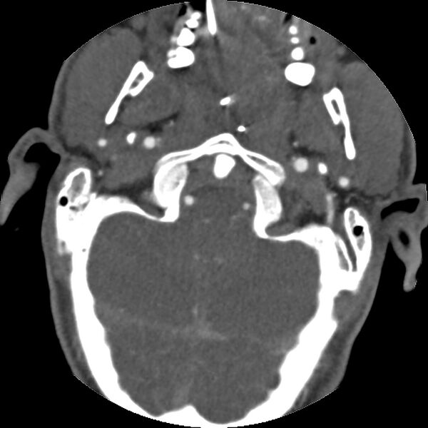 File:Cervical spine fractures with vertebral artery dissection (Radiopaedia 32135-33078 D 70).jpg