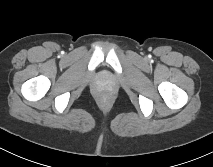 Cesarean scar endometriosis (Radiopaedia 82925-97262 A 90).jpg