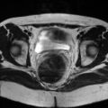 Cesarian section scar endometriosis (Radiopaedia 66520-75799 Axial T2 15).jpg
