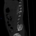 Chance fracture with duodenal and pancreatic lacerations (Radiopaedia 43477-50042 Sagittal bone window 2).jpg