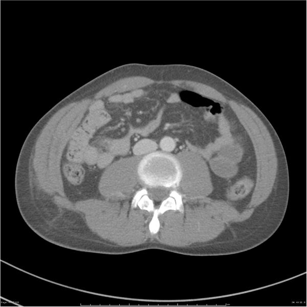 File:Chest and abdomen multi-trauma (Radiopaedia 26294-26426 bone window 49).jpg