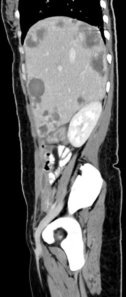 File:Choriocarcinoma liver metastases (Radiopaedia 74768-85766 C 127).jpg