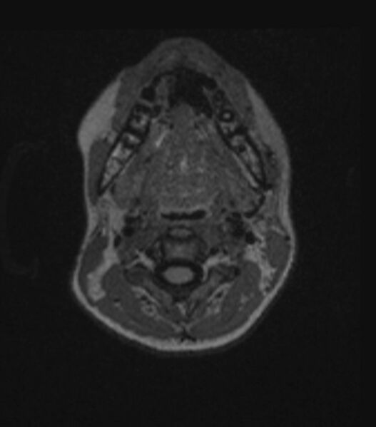 File:Choroid plexus carcinoma (Radiopaedia 91013-108553 Axial FLAIR C+ 32).jpg
