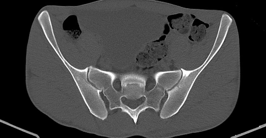 Chronic osteomyelitis (with sequestrum) (Radiopaedia 74813-85822 Axial non-contrast 9).jpg