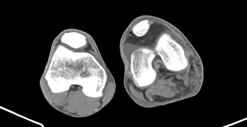 Chronic osteomyelitis (with sequestrum) (Radiopaedia 74813-85822 D 185).jpg