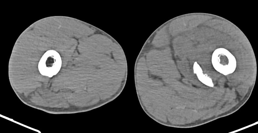 Chronic osteomyelitis (with sequestrum) (Radiopaedia 74813-85822 D 78).jpg