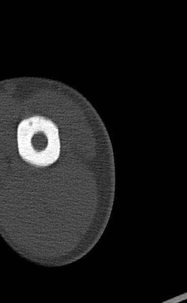 File:Chronic osteomyelitis of the distal humerus (Radiopaedia 78351-90971 Axial bone window 7).jpg