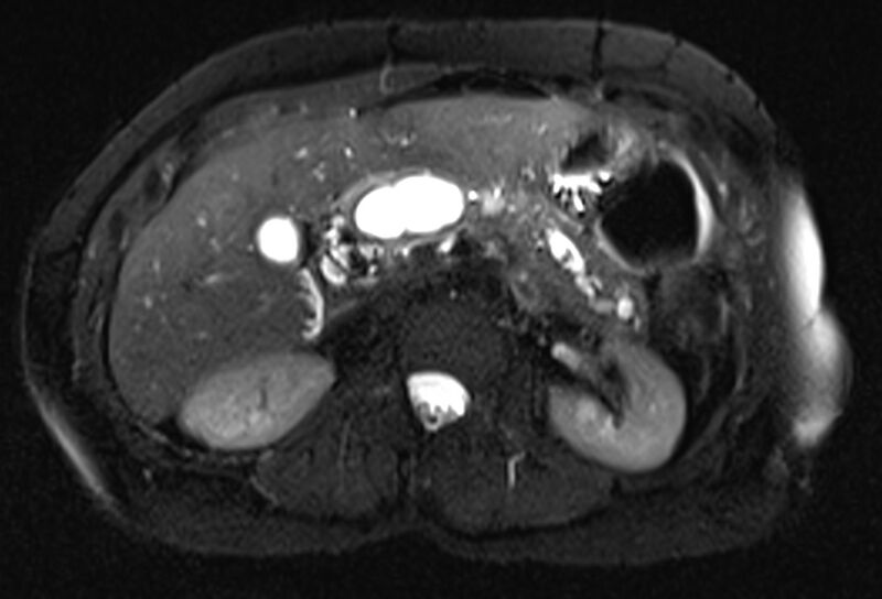 File:Chronic pancreatitis - pancreatic duct calculi (Radiopaedia 71818-82250 Axial T2 fat sat 27).jpg