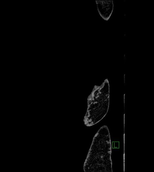File:Closed-loop small bowel obstruction-internal hernia (Radiopaedia 78439-91096 C 2).jpg