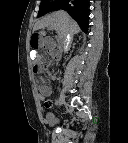 File:Closed-loop small bowel obstruction-internal hernia (Radiopaedia 78439-91096 C 88).jpg