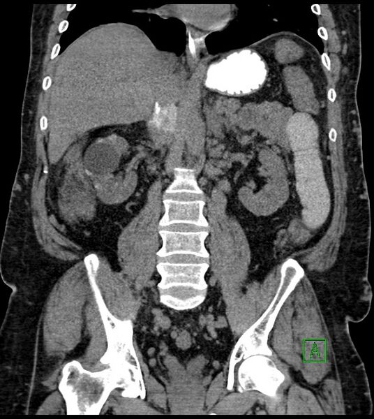 File:Closed-loop small bowel obstruction-internal hernia (Radiopaedia 78439-91096 Coronal non-contrast 62).jpg