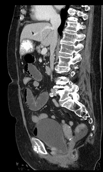 File:Closed loop small bowel obstruction - adhesions (Radiopaedia 59269-66611 C 63).jpg