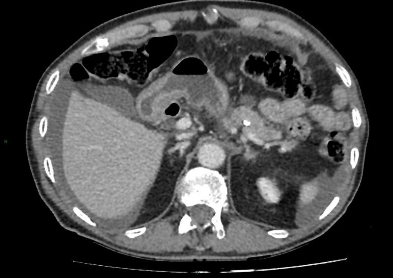 File:Closed loop small bowel obstruction with ischemia (Radiopaedia 84180-99456 A 29).jpg
