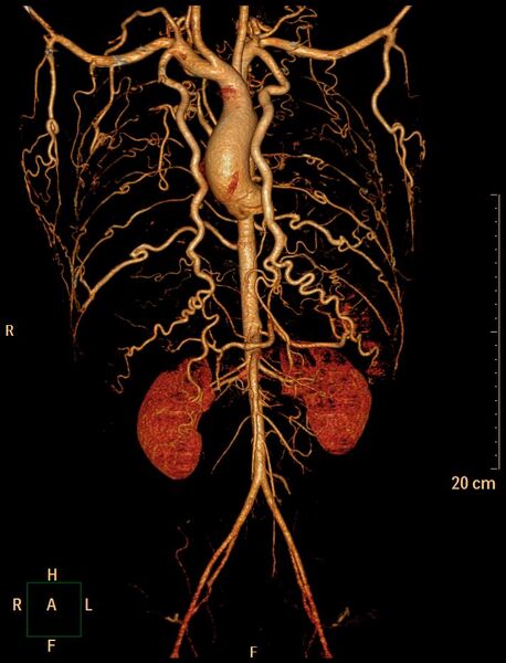 File:Coarctation of the aorta (Radiopaedia 27458-27657 3D 2).jpg