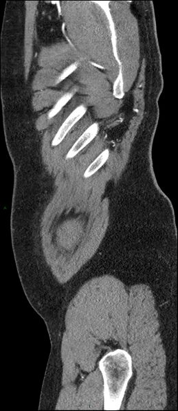 File:Coarctation of the aorta (Radiopaedia 74632-88521 C 312).jpg