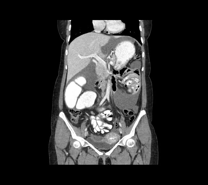 File:Cocoon abdomen with possible tubo-ovarian abscess (Radiopaedia 46235-50636 B 24).jpg