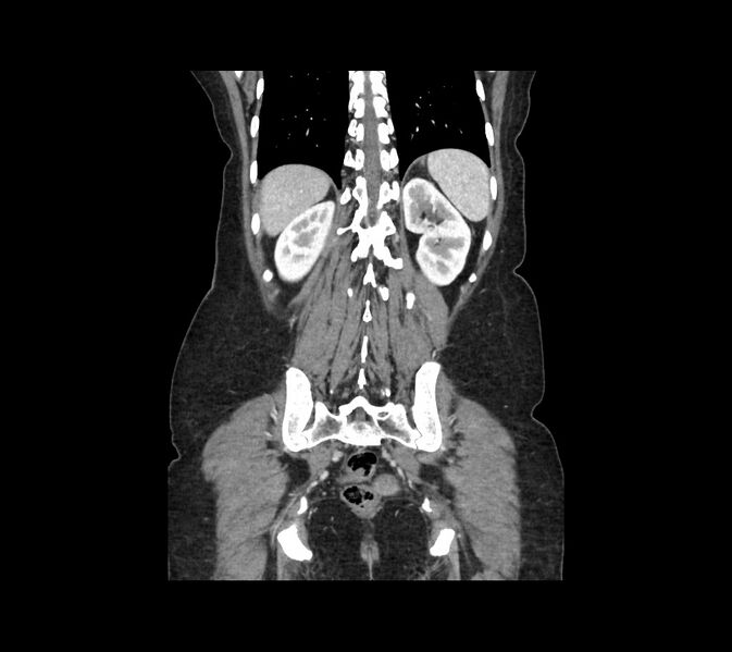 File:Cocoon abdomen with possible tubo-ovarian abscess (Radiopaedia 46235-50636 B 42).jpg