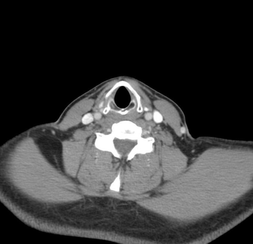 Colloid cyst of thyroid (Radiopaedia 22897-22923 Axial C+ delayed 52).jpg