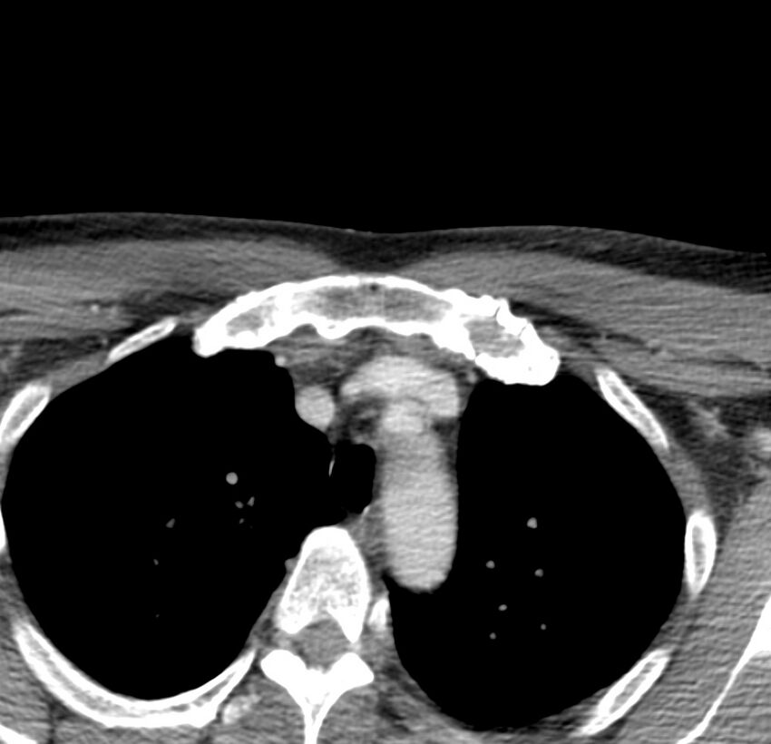 Colloid cyst of thyroid (Radiopaedia 22897-22923 Axial C+ delayed 85).jpg