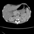 Colocolic fistula - Crohn disease (Radiopaedia 57063-63955 A 20).jpg