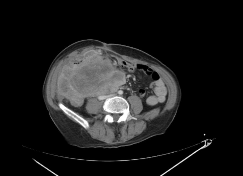File:Colon cancer mimicking renal cell carcinoma (Radiopaedia 28986-29335 C 47).jpg