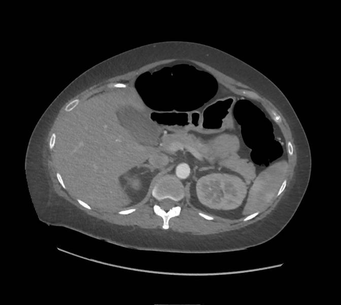 File:Colonic pseudo-obstruction (Radiopaedia 79752-92980 A 56).png