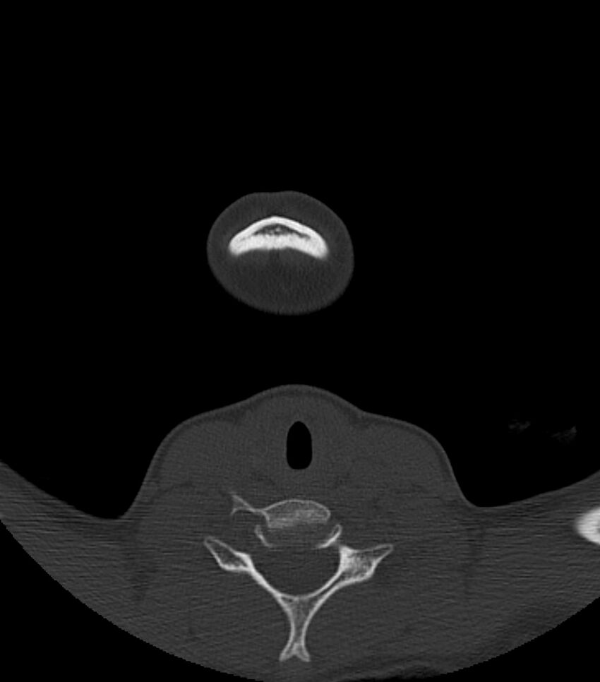 Nasoorbitoethmoid fracture (Radiopaedia 90044-107205 Axial bone window 8).jpg