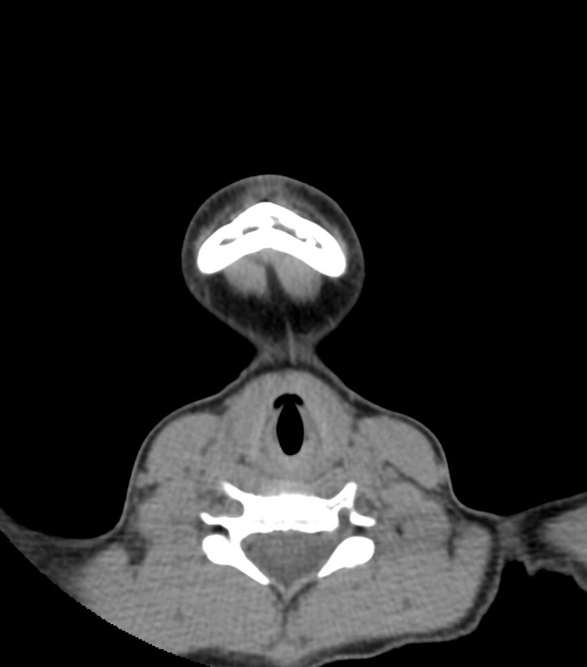 Nasoorbitoethmoid fracture (Radiopaedia 90044-107205 Axial non-contrast 23).jpg