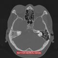 Nasopharyngeal carcinoma recurrence - skull base destruction (Radiopaedia 29107-29490 Axial bone window 79).jpg