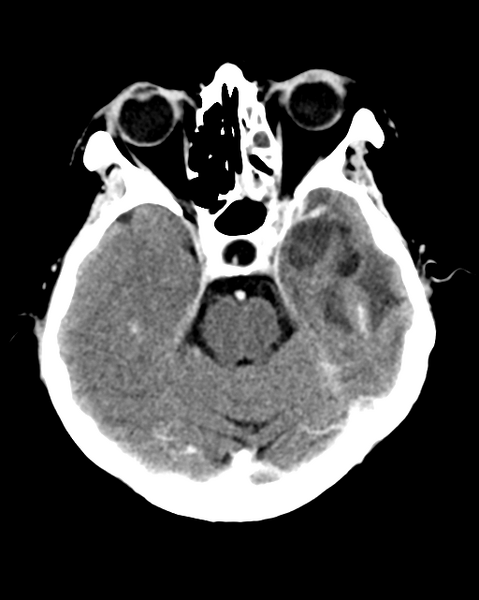 File:Nasopharyngeal carcinoma with cerebral abscess (Radiopaedia 43018-46275 Axial C+ delayed 18).png