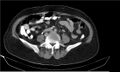 Necrotizing pancreatitis (Radiopaedia 20595-20495 Axial C+ delayed 29).jpg