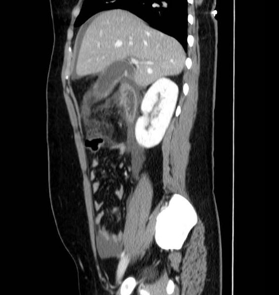 File:Necrotizing pancreatitis (Radiopaedia 23001-23031 C 21).jpg