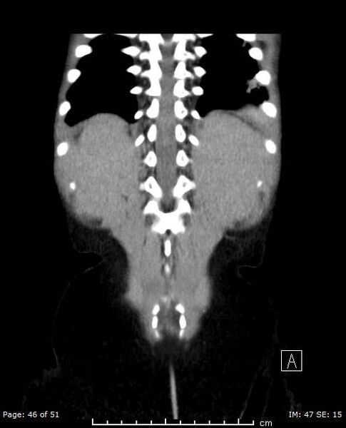 File:Nephroblastomatosis (Radiopaedia 41934-44935 B 46).jpg