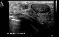 Neurofibromatosis of breast (Radiopaedia 5921-7462 C 1).jpg
