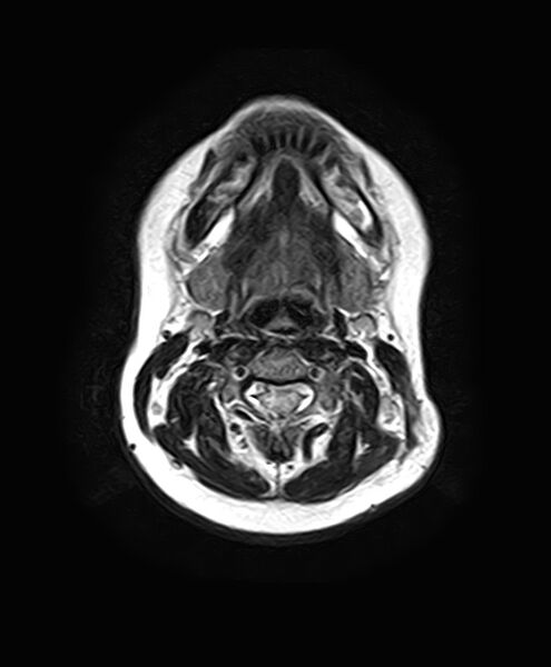 File:Neurofibromatosis type 2 (Radiopaedia 66211-75401 Axial FLAIR 1).jpg