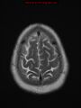 Neuroglial cyst (Radiopaedia 10713-11184 Axial T2 3).jpg