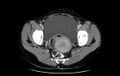 Non-puerperal uterine inversion (Radiopaedia 78343-91094 A 43).jpg