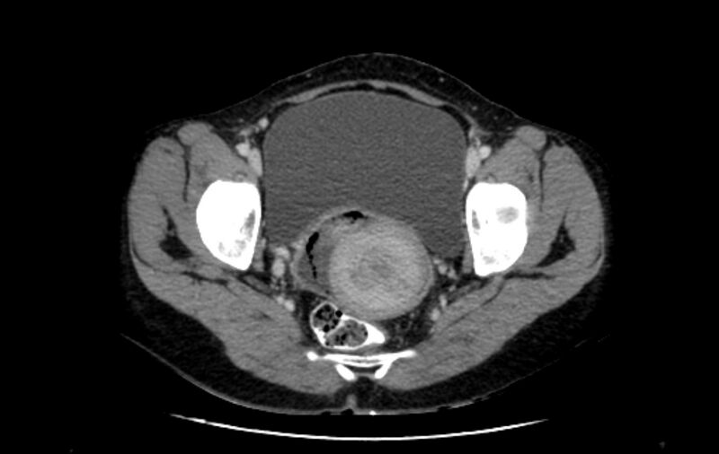 File:Non-puerperal uterine inversion (Radiopaedia 78343-91094 A 43).jpg