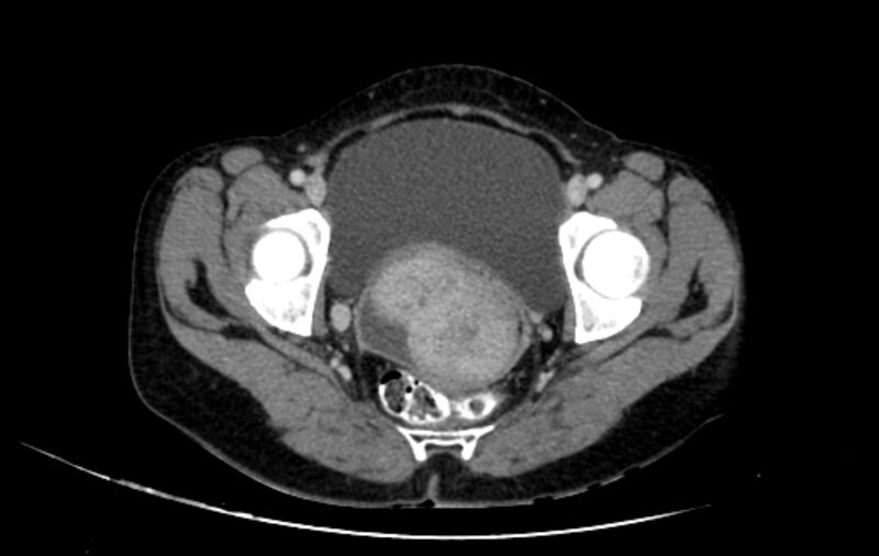File:Non-puerperal uterine inversion (Radiopaedia 78343-91094 A 51).jpg