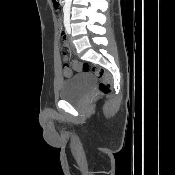 File:Normal CT angiogram of pelvis (Radiopaedia 45390-49430 C 35).jpg