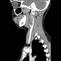 Normal CT of the neck (Radiopaedia 14575-14500 Sagittal C+ 37).jpg