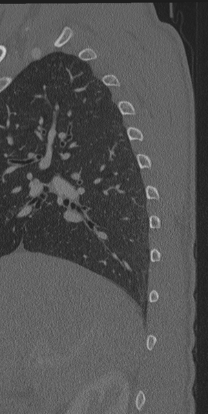 File:Normal CT thoracic spine (Radiopaedia 40181-42688 Sagittal bone window 67).png