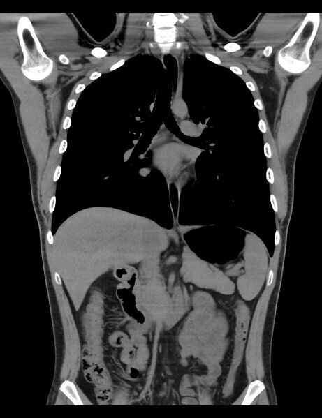 File:Normal CT virtual gastroscopy (Radiopaedia 29960-30501 E 6).jpg